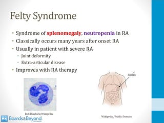 Felty Syndrome
• Syndrome of splenomegaly, neutropenia in RA
• Classically occurs many years after onset RA
• Usually in patient with severe RA
• Joint deformity
• Extra-articular disease
• Improves with RA therapy
Wikipedia/Public Domain
Bob Blaylock/Wikipedia
 