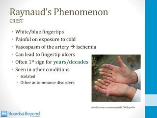 Raynaud’s Phenomenon
CREST
• White/blue fingertips
• Painful on exposure to cold
• Vasospasm of the artery → ischemia
• Can lead to fingertip ulcers
• Often 1st sign for years/decades
• Seen in other conditions
• Isolated
• Other autoimmune disorders
Jamclaassen~commonswiki /Wikipedia
 