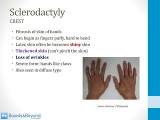 Sclerodactyly
CREST
• Fibrosis of skin of hands
• Can begin as fingers puffy, hard to bend
• Later, skin often be becomes shiny skin
• Thickened skin (can’t pinch the skin)
• Loss of wrinkles
• Severe form: hands like claws
• Also seen in diffuse type
James Heilman /Wikipedia
 