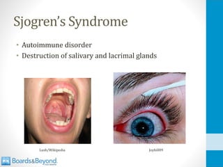 Sjogren’s Syndrome
• Autoimmune disorder
• Destruction of salivary and lacrimal glands
Lusb/Wikipedia Joyhill09
 