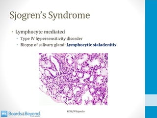 Sjogren’s Syndrome
• Lymphocyte mediated
• Type IV hypersensitivity disorder
• Biopsy of salivary gland: Lymphocytic sialadenitis
KGH/Wikipedia
 
