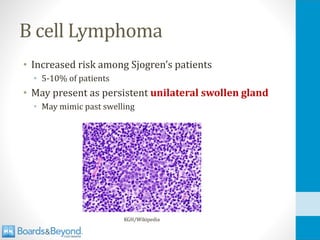 B cell Lymphoma
• Increased risk among Sjogren’s patients
• 5-10% of patients
• May present as persistent unilateral swollen gland
• May mimic past swelling
KGH/Wikipedia
 