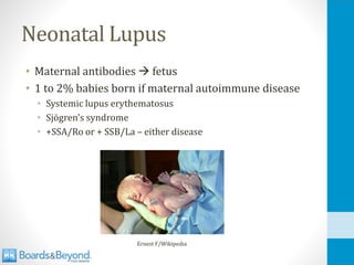 Neonatal Lupus
• Maternal antibodies → fetus
• 1 to 2% babies born if maternal autoimmune disease
• Systemic lupus erythematosus
• Sjögren's syndrome
• +SSA/Ro or + SSB/La – either disease
Ernest F/Wikipedia
 