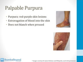 Palpable Purpura
• Purpura: red-purple skin lesions
• Extravagation of blood into the skin
• Does not blanch when pressed
* Images courtesy Dr. James Heilman and Wikipedia; used with permission
 