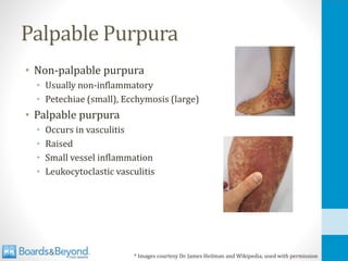 Palpable Purpura
• Non-palpable purpura
• Usually non-inflammatory
• Petechiae (small), Ecchymosis (large)
• Palpable purpura
• Occurs in vasculitis
• Raised
• Small vessel inflammation
• Leukocytoclastic vasculitis
* Images courtesy Dr. James Heilman and Wikipedia; used with permission
 