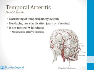 Temporal Arteritis
GiantCellArteritis
• Narrowing of temporal artery system
• Headache, jaw claudication (pain on chewing)
• If not treated → blindness
• Ophthalmic artery occlusion
Wikipedia/Public Domain
 