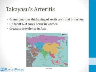Takayasu’s Arteritis
• Granulomatous thickening of aortic arch and branches
• Up to 90% of cases occur in women
• Greatest prevalence in Asia
Public Domain
 