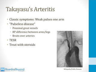 Takayasu’s Arteritis
• Classic symptoms: Weak pulses one arm
• "Pulseless disease"
• Proximal great vessels
• BP difference between arms/legs
• Bruits over arteries
• ↑ESR
• Treat with steroids
Wikipedia/Public Domain
 
