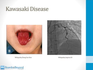 Kawasaki Disease
Wikipedia/Dong Soo Kim Wikipedia/mprice18
 