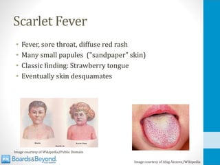 Scarlet Fever
• Fever, sore throat, diffuse red rash
• Many small papules ("sandpaper" skin)
• Classic finding: Strawberry tongue
• Eventually skin desquamates
Image courtesy of Wikipedia/Public Domain
Image courtesy of Afag Azizova/Wikipedia
 