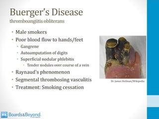Buerger’s Disease
thromboangiitisobliterans
• Male smokers
• Poor blood flow to hands/feet
• Gangrene
• Autoamputation of digits
• Superficial nodular phlebitis
• Tender nodules over course of a vein
• Raynaud's phenomenon
• Segmental thrombosing vasculitis
• Treatment: Smoking cessation
Dr. James Heilman/Wikipedia
 