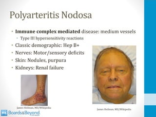 Polyarteritis Nodosa
• Immune complex mediated disease: medium vessels
• Type III hypersensitivity reactions
• Classic demographic: Hep B+
• Nerves: Motor/sensory deficits
• Skin: Nodules, purpura
• Kidneys: Renal failure
James Heilman, MD/Wikipedia
James Heilman, MD/Wikipedia
 