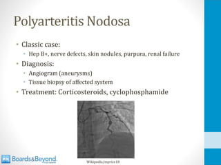 Polyarteritis Nodosa
• Classic case:
• Hep B+, nerve defects, skin nodules, purpura, renal failure
• Diagnosis:
• Angiogram (aneurysms)
• Tissue biopsy of affected system
• Treatment: Corticosteroids, cyclophosphamide
Wikipedia/mprice18
 