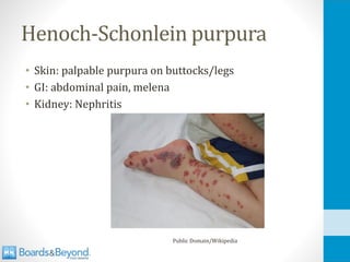 Henoch-Schonlein purpura
• Skin: palpable purpura on buttocks/legs
• GI: abdominal pain, melena
• Kidney: Nephritis
Public Domain/Wikipedia
 