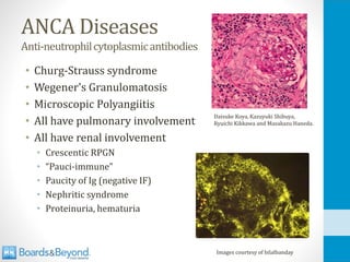 ANCA Diseases
Anti-neutrophilcytoplasmicantibodies
• Churg-Strauss syndrome
• Wegener's Granulomatosis
• Microscopic Polyangiitis
• All have pulmonary involvement
• All have renal involvement
• Crescentic RPGN
• “Pauci-immune”
• Paucity of Ig (negative IF)
• Nephritic syndrome
• Proteinuria, hematuria
Images courtesy of bilalbanday
Daisuke Koya, Kazuyuki Shibuya,
Ryuichi Kikkawa and Masakazu Haneda.
 