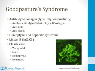 Goodpasture’s Syndrome
• Antibody to collagen (type II hypersensitivity)
• Antibodies to alpha-3 chain of type IV collagen
• Anti-GBM
• Anti-alveoli
• Hemoptysis and nephritic syndrome
• Linear IF (IgG, C3)
• Classic case
• Young adult
• Male
• Hemoptysis
• Hematuria
Images courtesy of bilalbanday
 