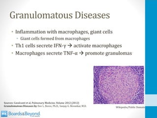 Granulomatous Diseases
• Inflammation with macrophages, giant cells
• Giant cells formed from macrophages
• Th1 cells secrete IFN-γ → activate macrophages
• Macrophages secrete TNF-α → promote granulomas
Sources: Cavalcanti et al, Pulmonary Medicine, Volume 2012 (2012)
Granulomatous Diseases by Dov L. Boros, Ph.D., Sanjay G. Revankar, M.D. Wikipedia/Public Domain
 