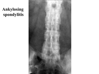 Ankylos ing   spondylitis 