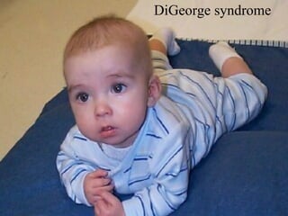 DiGeorge  syndrom e 