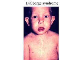 DiGeorge syndrom e 