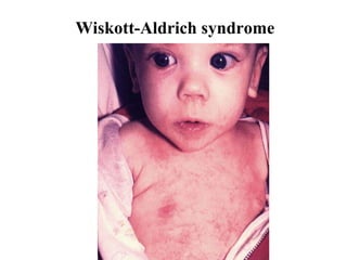 Wiskott-Aldrich syndrom e 
