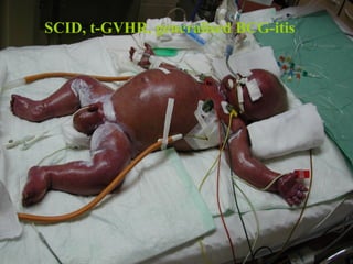 SCID, t-GVHR, generalised BCG-itis 