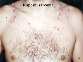 Kaposh i  sar coma 
