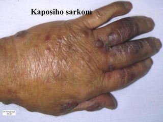 Kaposiho sarkom 