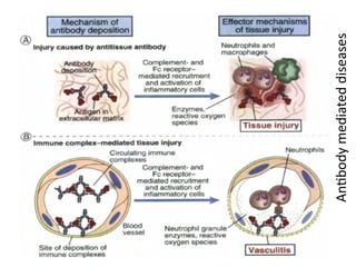 Antibody
mediated
diseases
 