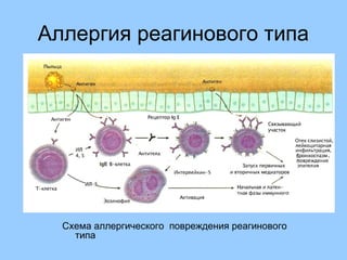 Аллергия реагинового типа
Схема аллергического повреждения реагинового
типа
 