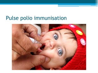 Pulse polio immunisation
 