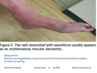 University of Nairobi ISO 9001:2008 41 Certified http://www.uonbi.ac.ke
Adapted from
https://www.hmpgloballearningnetwork.com/site/thederm/site/cathlab/event/derm-
dx-what-red-rash-leg
 