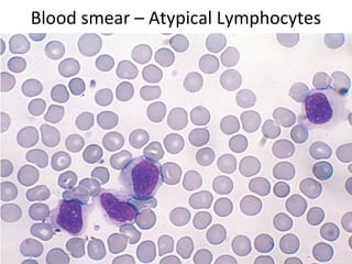 Blood smear – Atypical Lymphocytes
 
