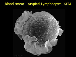 Blood smear – Atypical Lymphocytes - SEM
 