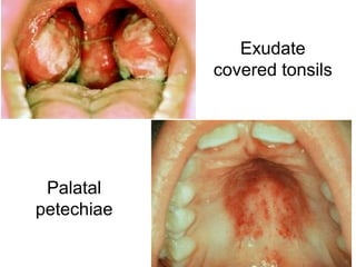Exudate
covered tonsils
Palatal
petechiae
 