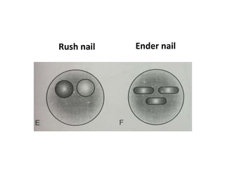 Rush nail Ender nail
 