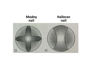 Modny
nail
Halloran
nail
 