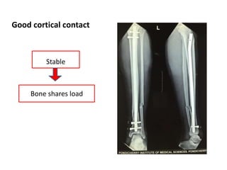 Good cortical contact
Bone shares load
Stable
 