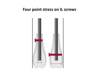 Four point stress on IL screws
 