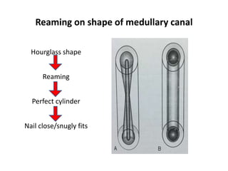 Reaming on shape of medullary canal
Hourglass shape
Reaming
Perfect cylinder
Nail close/snugly fits
 