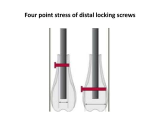 Four point stress of distal locking screws
 