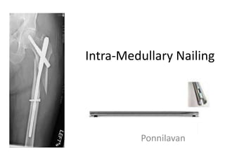 Intra-Medullary Nailing
Ponnilavan
 