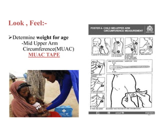 Look , Feel:-
Determine weight for age
-Mid Upper Arm
Circumference(MUAC)
MUAC TAPE
30
 