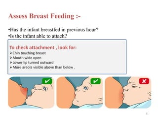 Assess Breast Feeding :-
•Has the infant breastfed in previous hour?
•Is the infant able to attach?
To check attachment , look for:
Chin touching breast
Mouth wide open
Lower lip turned outward
More areola visible above than below .
31
 