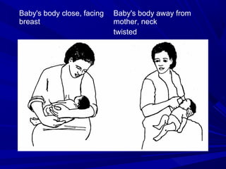 Baby's body close, facing
breast
Baby's body away from
mother, neck
twisted
 