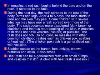 In measles, a red rash begins behind the ears and on the
neck. It spreads to the face.
During the next day, the rash spreads to the rest of the
body, arms and legs. After 4 to 5 days, the rash starts to
fade and the skin may peel. Some children with severe
infection may have mor e rash spread over more of the
body. The rash becomes more discolored (dark brown or
blackish), and there is more peeling of the skin. A measles
rash does not have vesicles (blisters) or pustules. The
rash does not itch. Do not confuse measles with other
common childhood rashes such as chicken pox, scabies
or heat rash. (The chicken pox rash is a generalized rash
with vesicles.
Scabies occurs on the hands, feet, ankles, elbows,
buttocks and axilla. It also itches.
Heat rash can be a generalized rash with small bumps
and vesicles that itch. A child with heat rash is not sick).
 