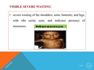 VISIBLE SEVERE WASTING
• severe wasting of the shoulders, arms, buttocks, and legs,
with ribs easily seen, and indicates presence of
marasmus.
I M N C I 115
 