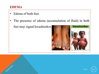 EDEMA
• Edema of both feet.
• The presence of edema (accumulation of fluid) in both
feet may signal kwashiorkor.
I M N C I 117
 