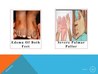 E d e m a O f B o t h
F e e t
S e v e re P a l m a r
P a l l o r
I M N C I 42
 