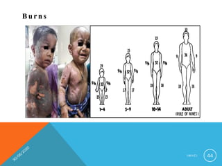 B u r n s
I M N C I 44
 